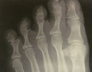 Arthritis - 5 Most Common Foot Problems