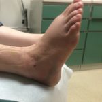 Most Common Foot and Ankle Injury In A Car Accident