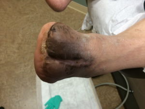 total toe amputation
