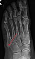 Fracture Base of 5th Metatarsal