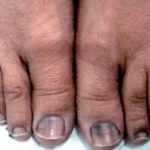 Chemotherapy Induced Nail Changes