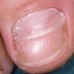 Chemotherapy Induced Nail Changes