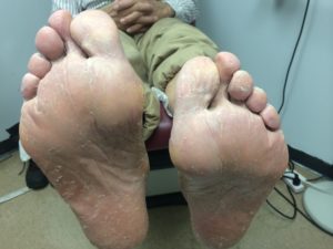 Athlete's Feet - 5 Most Common Foot Problems