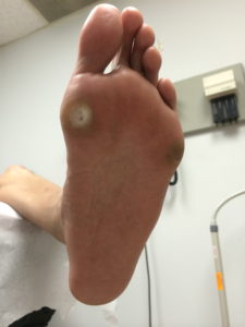 Diabetic Foot Ulcer and Calluses