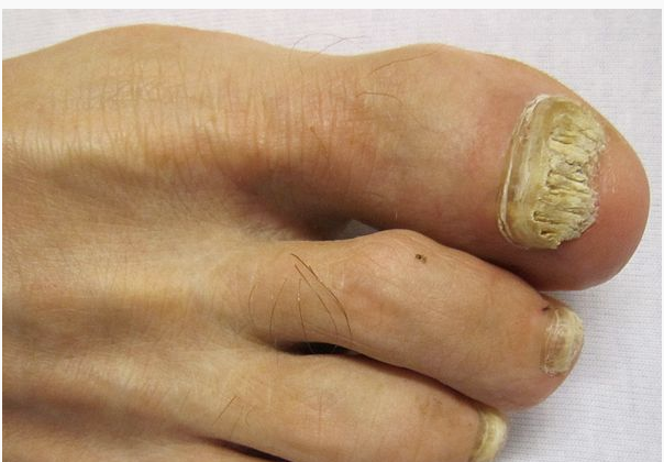 Why Do Some People Get Toenail Fungus And Others Don't! - Hollowbrook Foot  Specialists